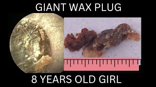 8 years old girl suffering from GIANT EARWAX PLUG [upl. by Tiebout12]