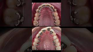 Lingual braces process [upl. by Esorbma124]