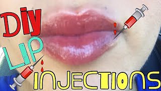 DIY LIP INJECTIONS [upl. by Nielsen]