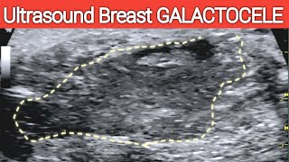 Ultrasound BREAST GALACTOCELE  A Lactating Breast  Complicated Milk Cyst [upl. by Nobe721]