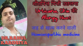 Urticaria Skin Allergy The Secret Homeopathic Remedy [upl. by Danas763]