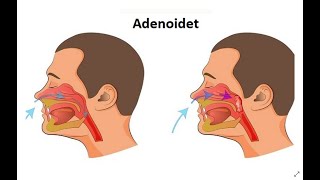 Kur kemi një infeksion te adenoidit kemi këto shenja kryesore [upl. by Ameh]