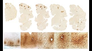 VABUCLF Brain Bank Researchers find Stage III CTE in Aaron Hernandezs Brain [upl. by Sherline]