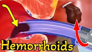 Watch out easiest way to remove Hemorrhoids Piles  3d Animation [upl. by Lupita]