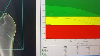 13Densitometría ósea [upl. by Goer]