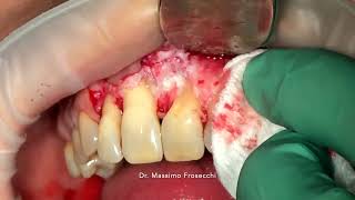 2 roots central incisor with periodontal furcation involvement [upl. by Harberd]