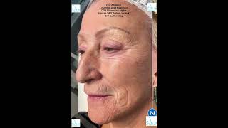 Full Ablation Laser for sun damage deep wrinkles and elastosis [upl. by Oinota]