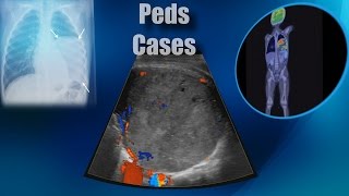 Cases  Chest  Pleuropulmonary Blastoma III [upl. by Rammaj]