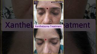 Xanthelasma removal treatment  Xanthelasma treatment laser  youtubeshort shorts xanthelasma [upl. by Acinej]