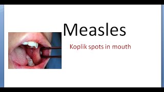 PSM 156 Measles Natural History Koplik spot differential rash diagnosis Rubeola powder SSPE vaccine [upl. by Camel]