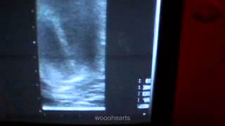 inverted ultrasound [upl. by Profant]