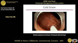 Standard polypectomy techniques Choosing the right technnique [upl. by Simonette]