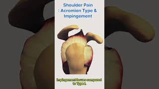 Shoulder Pain  Acromion Type and Impingement Syndrome [upl. by Ekal]