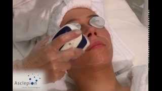 MeDioStar NeXT  Training video for hair removal face from Asclepion [upl. by Perlman]