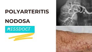 Poly Arteritis Nodosa [upl. by Tolkan]