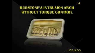 BURSTONE’S INTRUSION ARCH WITHOUT TORQUE CONTROL [upl. by Chandler218]