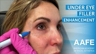 Under Eye Filler Enhancement [upl. by Naesar]