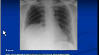 Chest xray interpretation Raised hemidiaphragm [upl. by Ttenna]