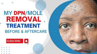 DPN mole removal Treatment before amp Aftercare Part 1 [upl. by Etnoval]