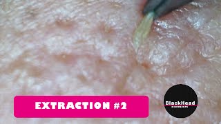 Whitehead and BlackHead RemovalExtraction 2 Reedition [upl. by Adnovahs]