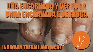 Ingrown toenail amp wart  Uña encarnada y verruga Podología Integral podologiaintegral [upl. by Stoffel]