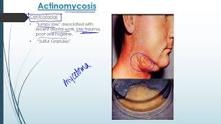 Actinomyces [upl. by Anig]