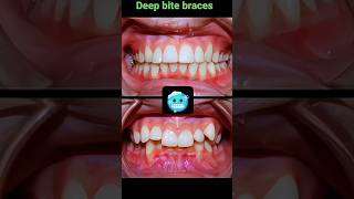 Braces process deep bite braces orthodontist dentist deepbite [upl. by Zul]