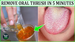 How to Get Rid of Oral Thrush Naturally In 5 Minutes  Oral Thrush Home Remedies  Dental Hygiene [upl. by Tnecnivleahcim]