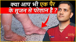 One Leg Swelling or Single Leg Swelling Causes and Treatment  Dr Gaurav Gangwani IR [upl. by Moynahan]