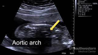 Understanding your fetal ultrasound [upl. by Anul]