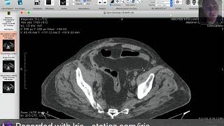 GIT  emergency  pneumoperitonium  1 [upl. by Nealon]