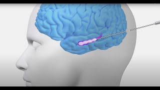 Laser Interstitial Thermal Therapy LITT for Epilepsy [upl. by Vtarj]