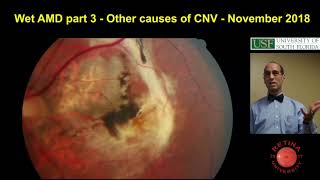 Other causes of choroidal neovascular membranes  wet AMD  Part 3 [upl. by Nolos]