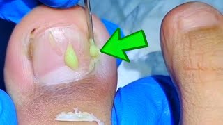 WARNING Ingrown Toenail Mistakes That Can LEAD TO INFECTION [upl. by Rabkin645]