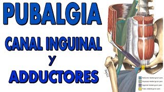 ¿Que es la PUBALGIA CANAL INGUINAL y ADDUCTORES [upl. by Leinoto595]