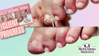 PINCER Toenail Transformation Journey  3rd Visit [upl. by Giarla]