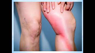 What is Phlebitis and How is it Treated [upl. by Ecinnahs]