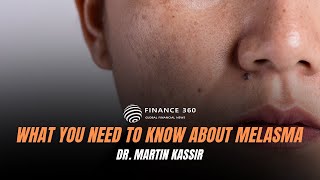 What You Need to Know About Melasma  Dr Martin Kassir  TheFinance 360 [upl. by Witkin794]