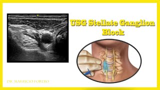 USG Stellate Ganglion Block [upl. by Soluk]