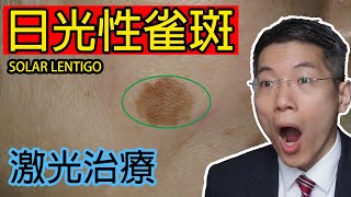 日光性雀斑  激光治療  solar lentigo  laser treatment  皮膚專科  Dermatologist [upl. by Hegyera]