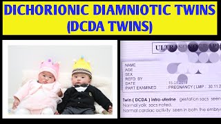 DCDA TWIN PREGNANCY IN HINDI DCDA TWINS MEANING DICHORIONIC DIAMNIOTIC TWINS  2023 twins [upl. by Ahsiak201]