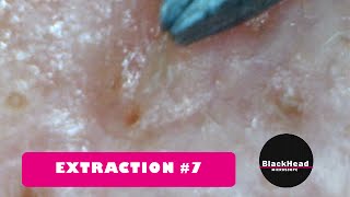 Whitehead and BlackHead RemovalExtraction 7 New One [upl. by Khudari]