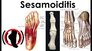 Sesamoiditis  Treatment Complications [upl. by Blossom998]