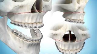 Maxillary Advancement Surgery [upl. by Anivid56]