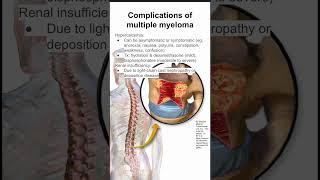 Complications of multiple myeloma [upl. by Ecirtap748]