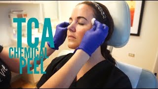 TCA Chemical Peel with Renata Block at Pinski Dermatology Chicago [upl. by Atsirk]