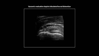 Lobulated subacromialsubdeltoid bursitis on shoulder ultrasound [upl. by Valtin]