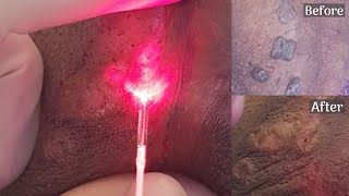 Warts Removal With Advanced Laser Treatment  Laven Clinic Group [upl. by Carlye437]