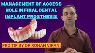 Management of Access hole in final dental implant prosthesis  Pro Tip by Dr Rohan Virani [upl. by Pan847]