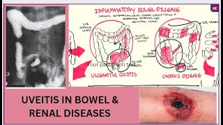 UVEITIS IN BOWEL amp RENAL DISEASES KanskiSeries 2022 [upl. by Mooney]